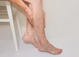 Проширени вени може да спречите на следниве начини