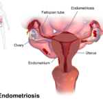 EndometriosisPregnancy