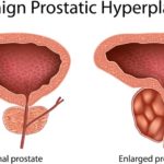 PROSTATA