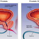 PROSTATA 2