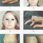 Sclerodermia_107