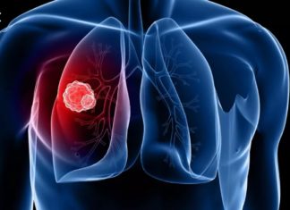 Најкомплицираниот вид рак кој создава микс од различни клетки на тумори и понатаму ги загрижува научниците