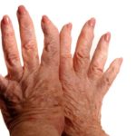 scleroderma-alodokter