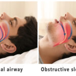 sleep-apnea-825×500