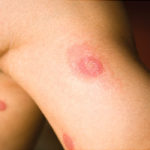 ringworm circles