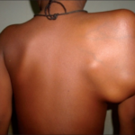 Clinical-photograph-showing-massive-scapular-swelling