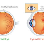 Diabetic-Retinopathy