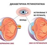 Dijabetesna-retinopatija