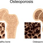 Image-of-osteoporosis-bones