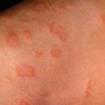 Medical Photo, leg, ringworm, tinea corporis, Skin
