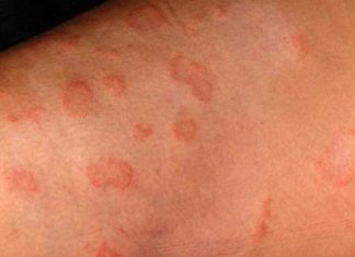 Ако забележите вакви кругови на кожата, веднаш на лекар! Заразно е!