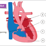 Tetrology-of-Fallot