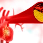 Tres-aspectos-que-debes-saber-sobre-la-prevencion-de-la-aterosclerosis
