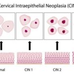 cervical-dysplasia-1-CIN-