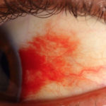 diabetic-retinopathy-02