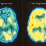 princ_rm_pet_scan_of_depressed_brain