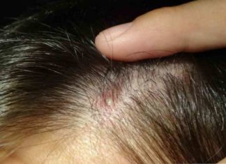 Зошто се појавуваат акни на темето и како да се ослободите од нив?