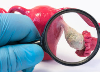 Ова е клучен симптом за рак на јајници што милиони жени го игнорираат и одат на доктор кога е веќе доцна