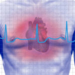 Heart Attack
