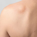 LIPOMA