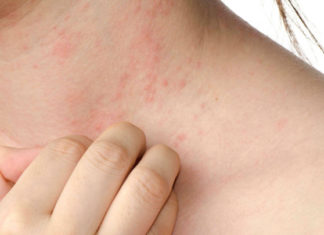 Осипот, црвенилото и чешањето може да се знак за рак, еве како да знаете кога состојбата е сериозна