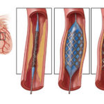 STENT
