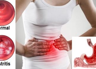 Симптоми и домашен тест кои ќе ви откријат дали боледувате од гастритис