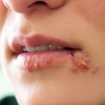 herpes-is-an-infection-caused-by-the-herpes-simplex-virus-with-symptoms-including-cold-sores-on-the-mouth