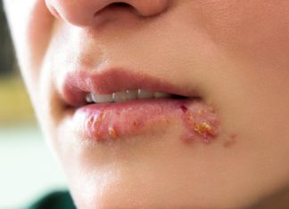 Симптомите на херпес може да се појават и по два дена, а некогаш и години после заразата