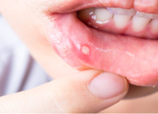 Зошто се појавуваат афтите и како да се спречат?!