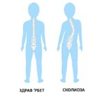 СКОЛИОЗА