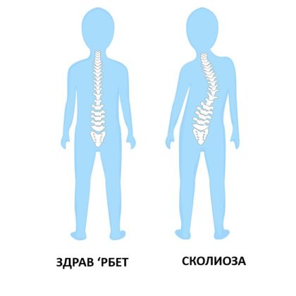 СКОЛИОЗА - Panacea.mk