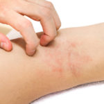 Women’s hands are scratching allergy to red rash on white background