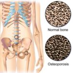 osteoporosis-300×300