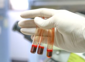 Нов крвен тест открива над 50 видови карцином и тоа во почетен стадиум