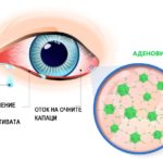 Virusni-konjunktivitis-simptomi-ilustracija
