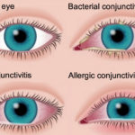 conjunctivitis_symptoms