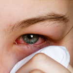 pink eye