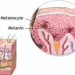 MELANOM