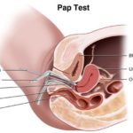 pap-test