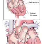 Left Ventricular Hypertrophy Illustration