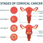 Stages of cervical cancer white infographic scheme