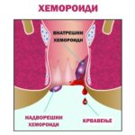 hemoroidalna-bolest (4)