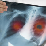 Lung,Cancer,Or,Pneumonia.,Doctor,Check,Up,X-ray,Image,Have