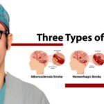 Infographic of common types of stroke