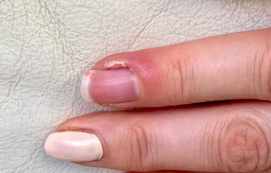 ПАРОНИХИЈА-болест на модерните и грицканите нокти