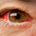 blood eyes