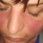 a-malar-rash-is-a-symptom-of-lupus-image-credit-doktorinternet-2013