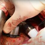 pumpa-mehanicko-srce-Zan-Mitrev-Clinik (5)