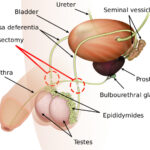 vasectomy 1